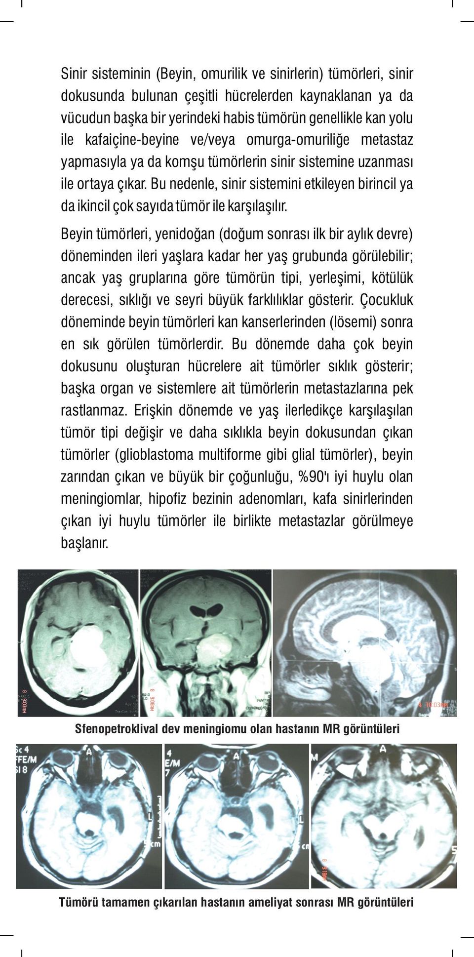 Bu nedenle, sinir sistemini etkileyen birincil ya da ikincil çok sayıda tümör ile karşılaşılır.