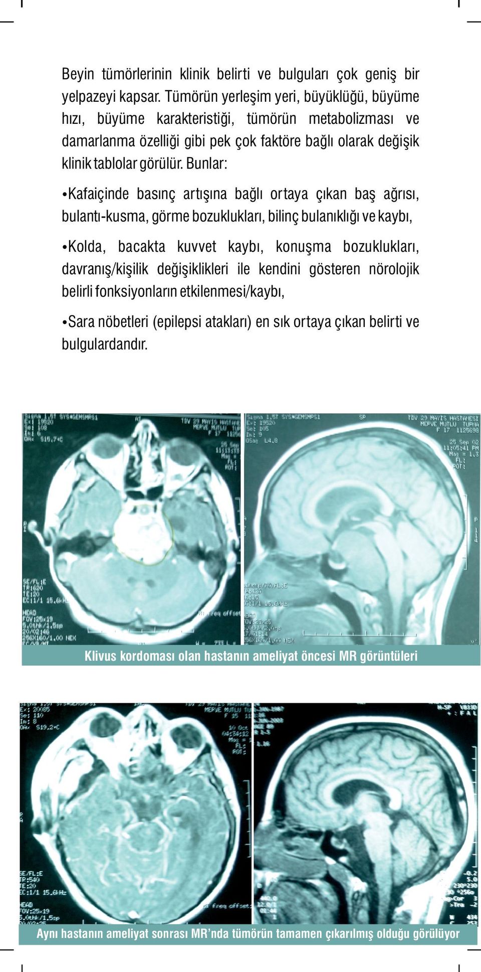 Bunlar: Kafaiçinde basınç artışına bağlı ortaya çıkan baş ağrısı, bulantı-kusma, görme bozuklukları, bilinç bulanıklığı ve kaybı, Kolda, bacakta kuvvet kaybı, konuşma bozuklukları,