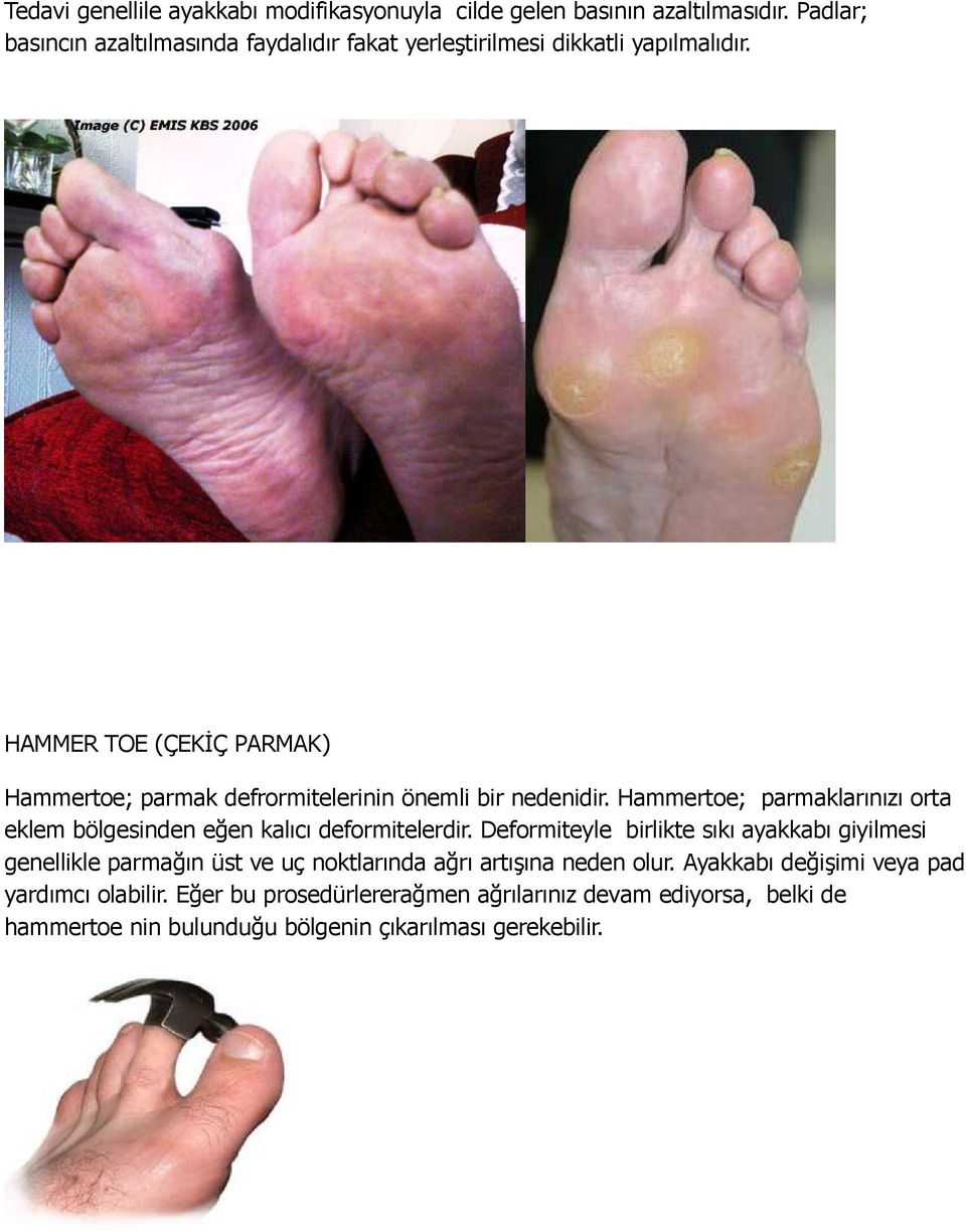 HAMMER TOE (ÇEKİÇ PARMAK) Hammertoe; parmak defrormitelerinin önemli bir nedenidir.