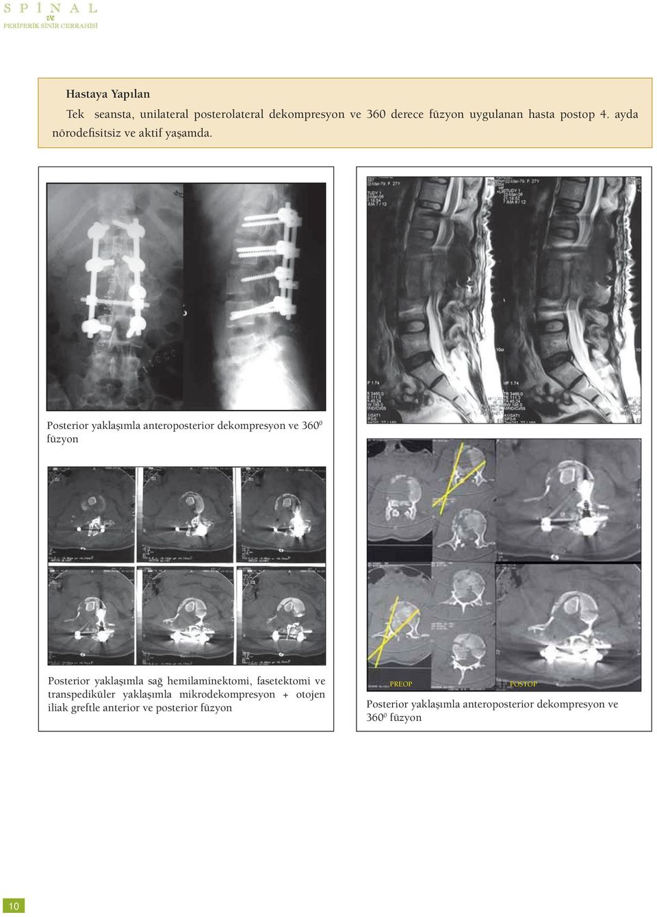 Posterior yaklaşımla anteroposterior dekompresyon ve 360 0 füzyon Posterior yaklaşımla sağ hemilaminektomi,