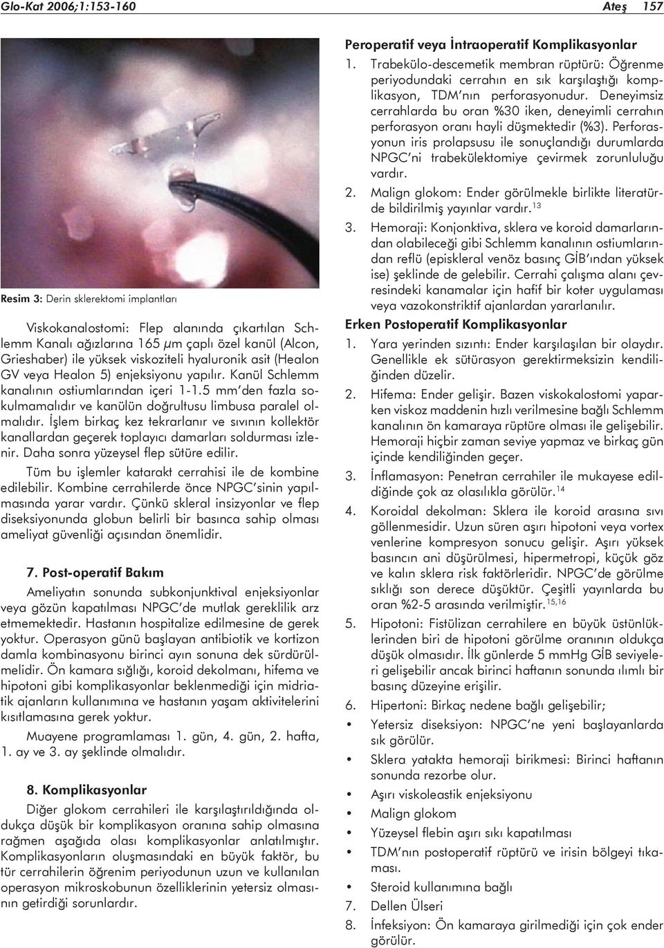 5 mm den fazla sokulmamalıdır ve kanülün doğrultusu limbusa paralel olmalıdır. İşlem birkaç kez tekrarlanır ve sıvının kollektör kanallardan geçerek toplayıcı damarları soldurması izlenir.