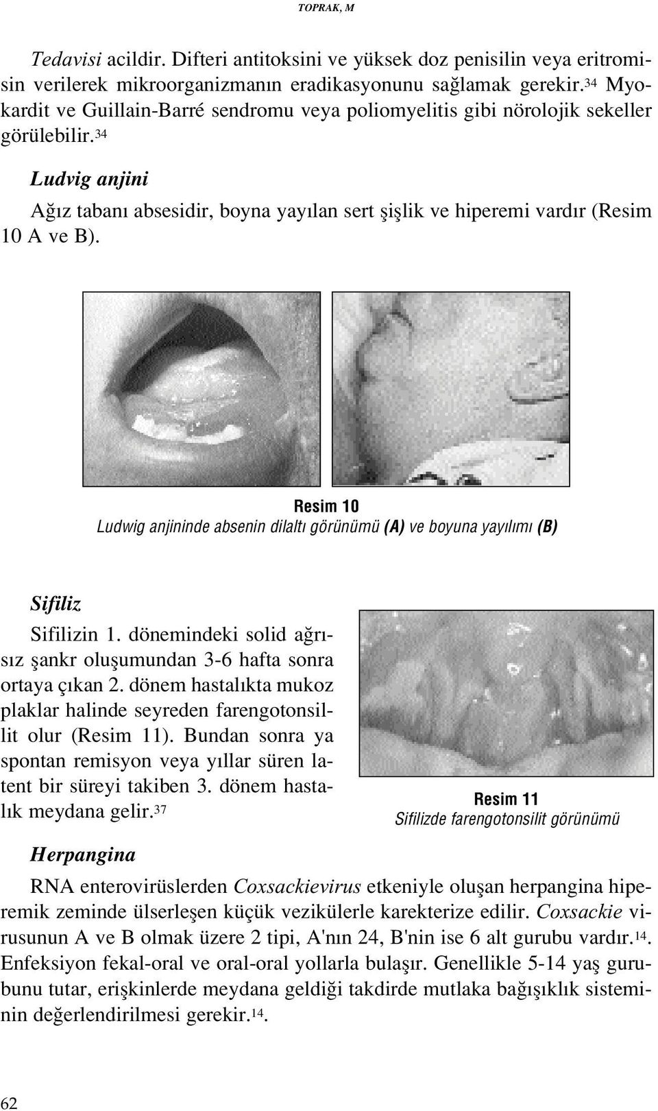 Resim 10 Ludwig anjininde absenin dilalt görünümü (A) ve boyuna yay l m (B) Sifiliz Sifilizin 1. dönemindeki solid a r - s z flankr oluflumundan 3-6 hafta sonra ortaya ç kan 2.