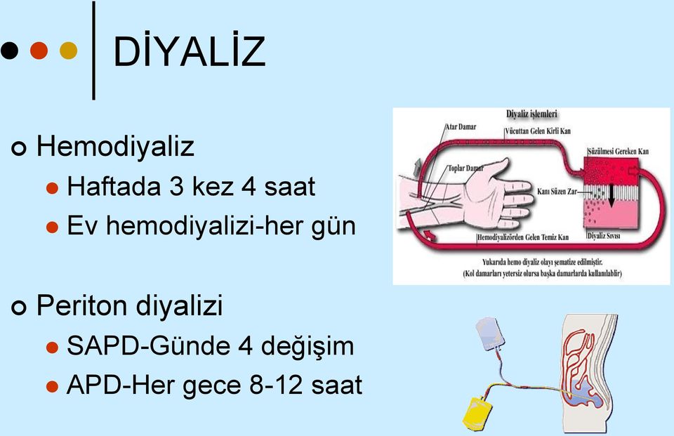 gün Periton diyalizi SAPD-Günde