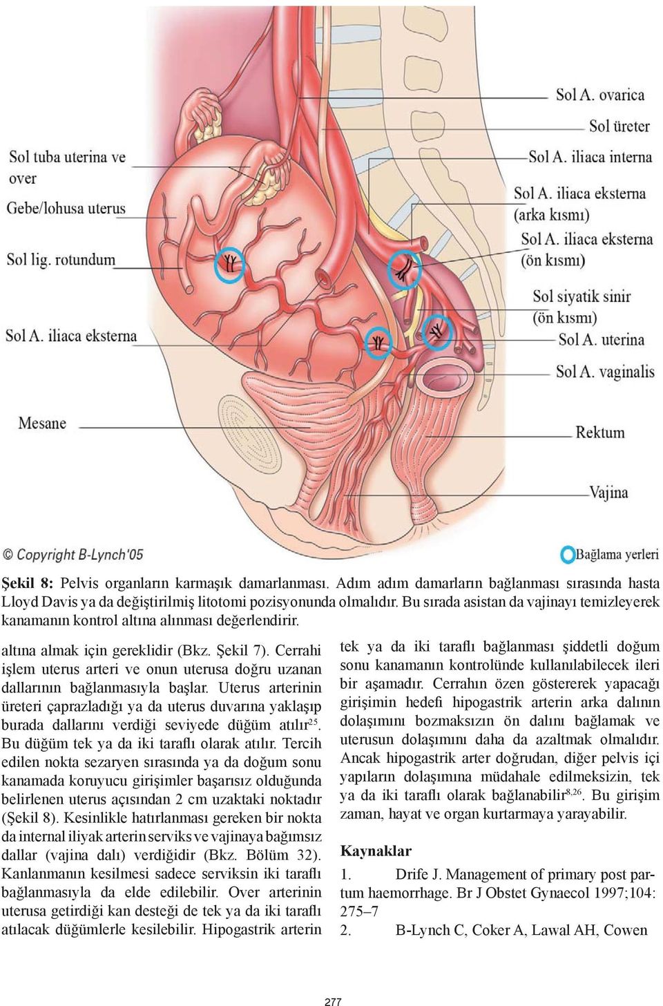 Cerrahi işlem uterus arteri ve onun uterusa doğru uzanan dallarının bağlanmasıyla başlar.
