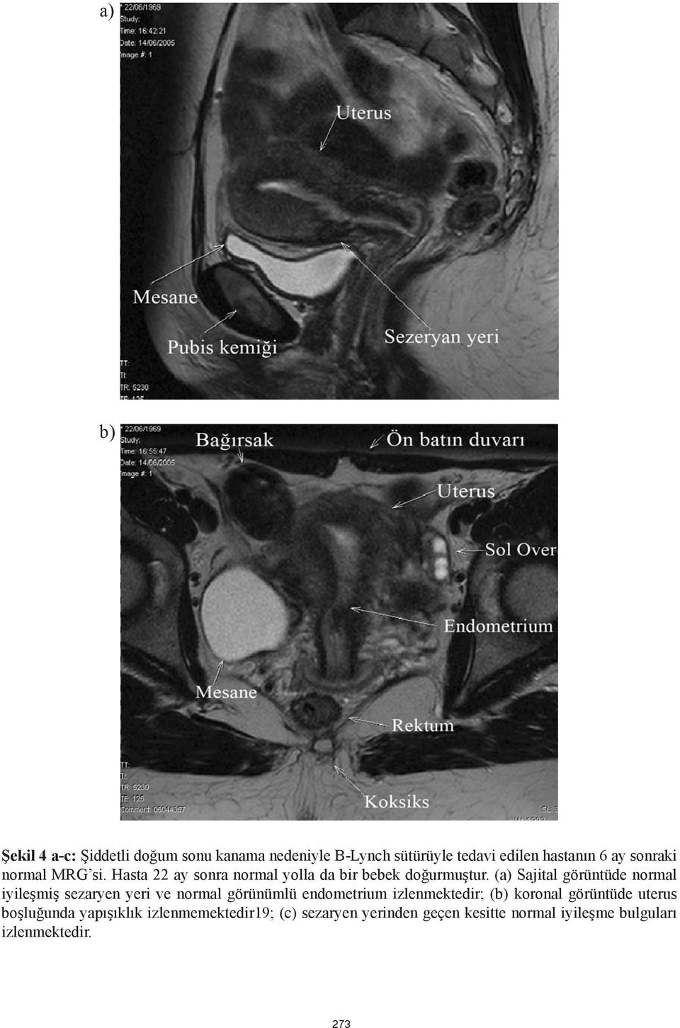 (a) Sajital görüntüde normal iyileşmiş sezaryen yeri ve normal görünümlü endometrium izlenmektedir; (b)