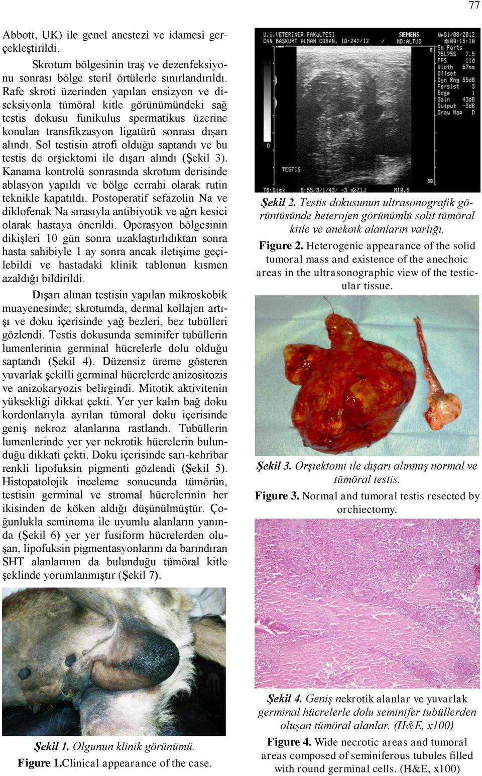 Sol testisin atrofi olduğu saptandı ve bu testis de orşiektomi ile dışarı alındı (Şekil 3).