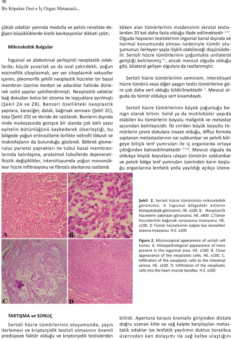 şekilli neoplastik hücreler bir bazal membran üzerine kordon ve adacıklar halinde dizilerek solid yapılar şekillendirmişti.