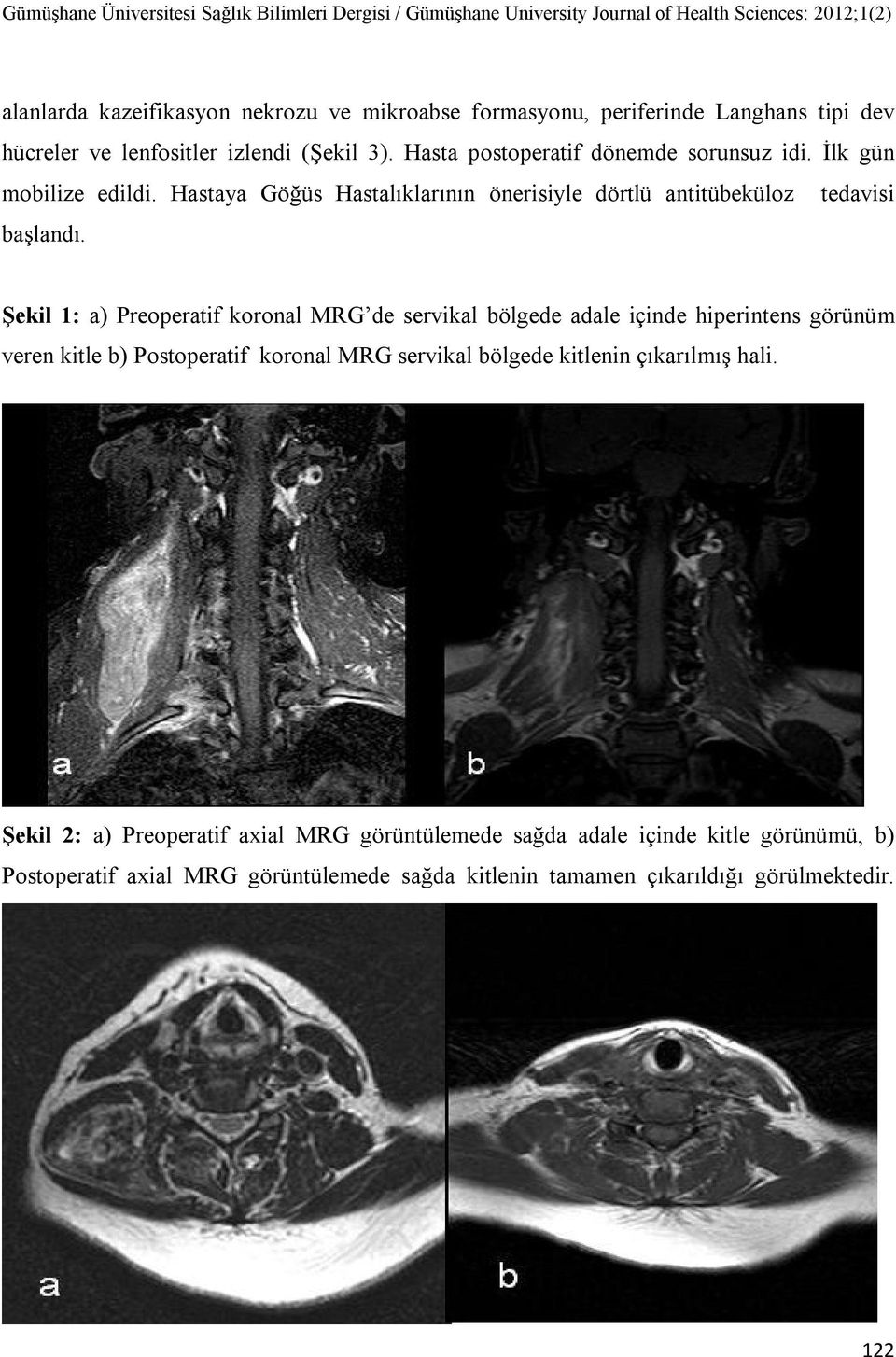 Şekil 1: a) Preoperatif koronal MRG de servikal bölgede adale içinde hiperintens görünüm veren kitle b) Postoperatif koronal MRG servikal bölgede kitlenin