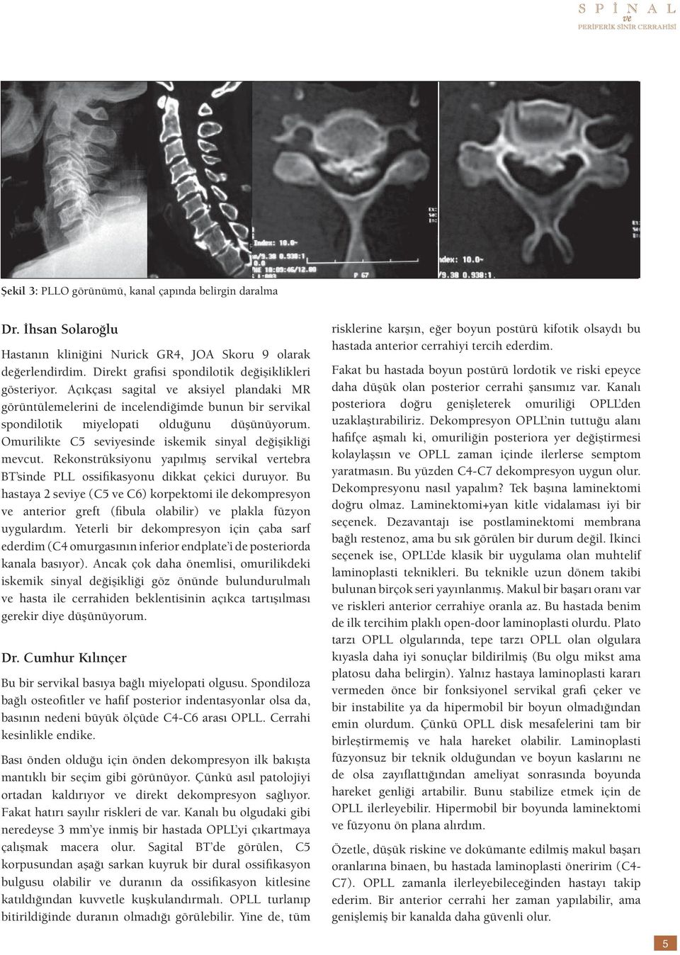 Rekonstrüksiyonu yapılmış servikal vertebra BT sinde PLL ossifikasyonu dikkat çekici duruyor.