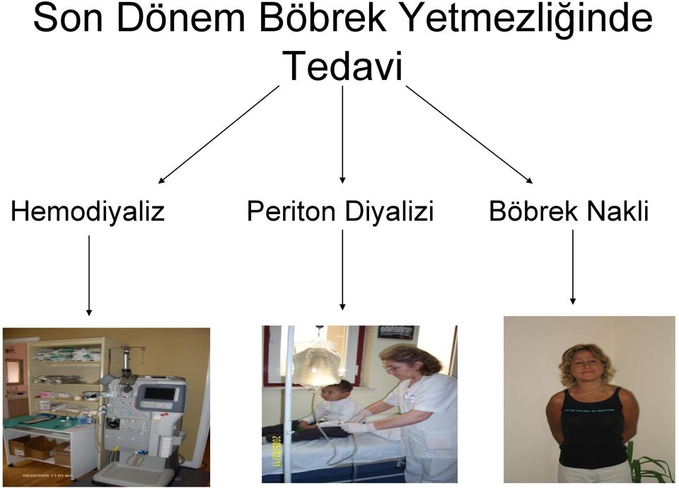 Tedavi Hemodiyaliz