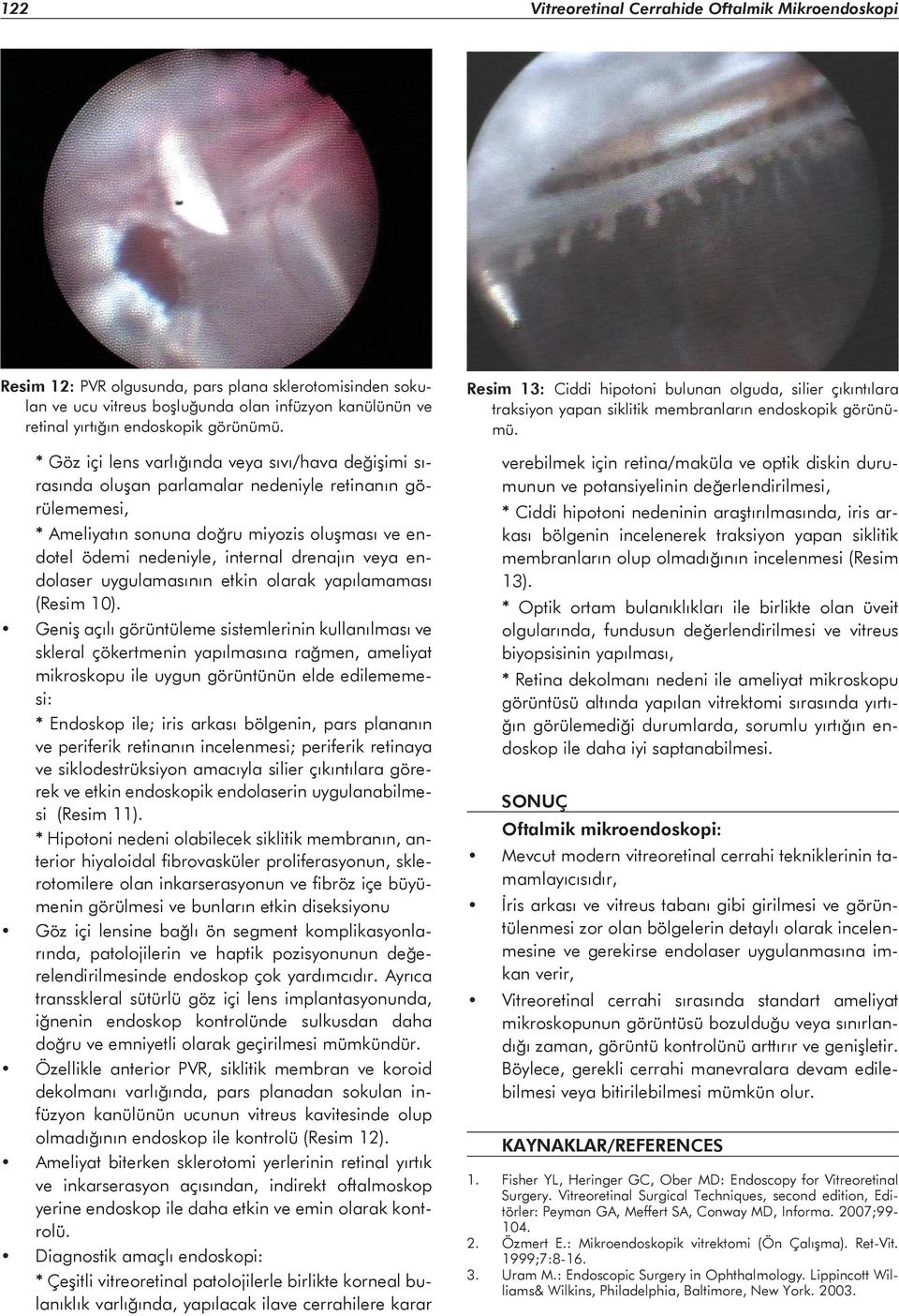 * Göz içi lens varlığında veya sıvı/hava değişimi sırasında oluşan parlamalar nedeniyle retinanın görülememesi, * Ameliyatın sonuna doğru miyozis oluşması ve endotel ödemi nedeniyle, internal