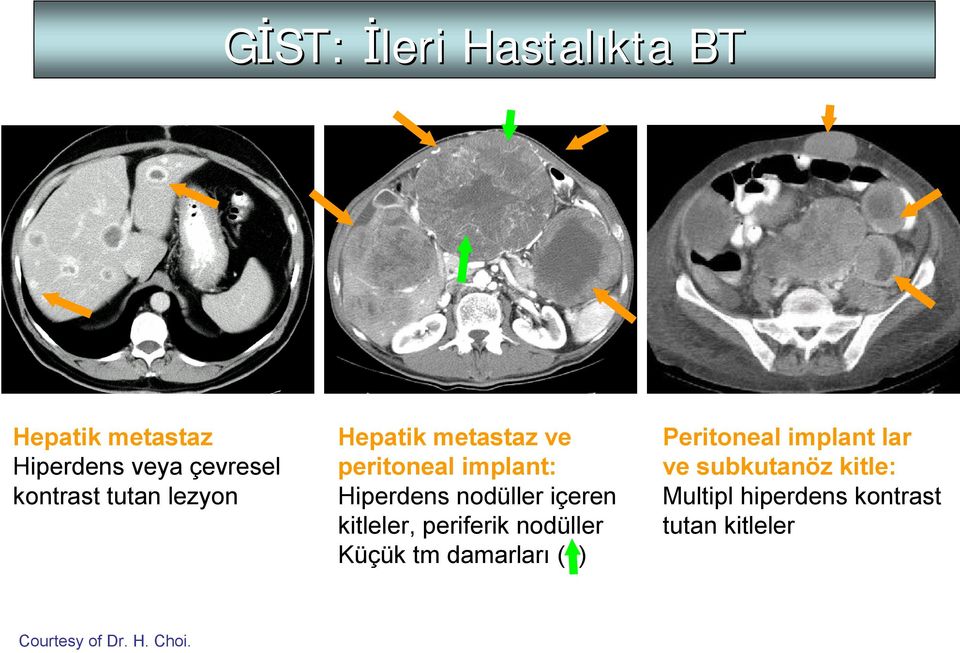 kitleler, periferik nodüller Küçük tm damarları ( ) Peritoneal implant lar ve