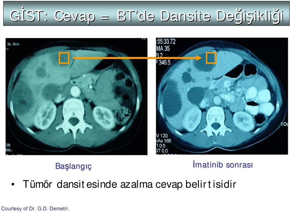 sonrası Tümör dansitesinde azalma