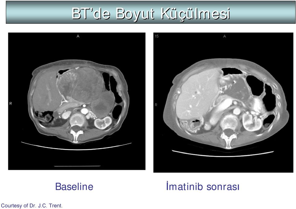 İmatinib sonrası