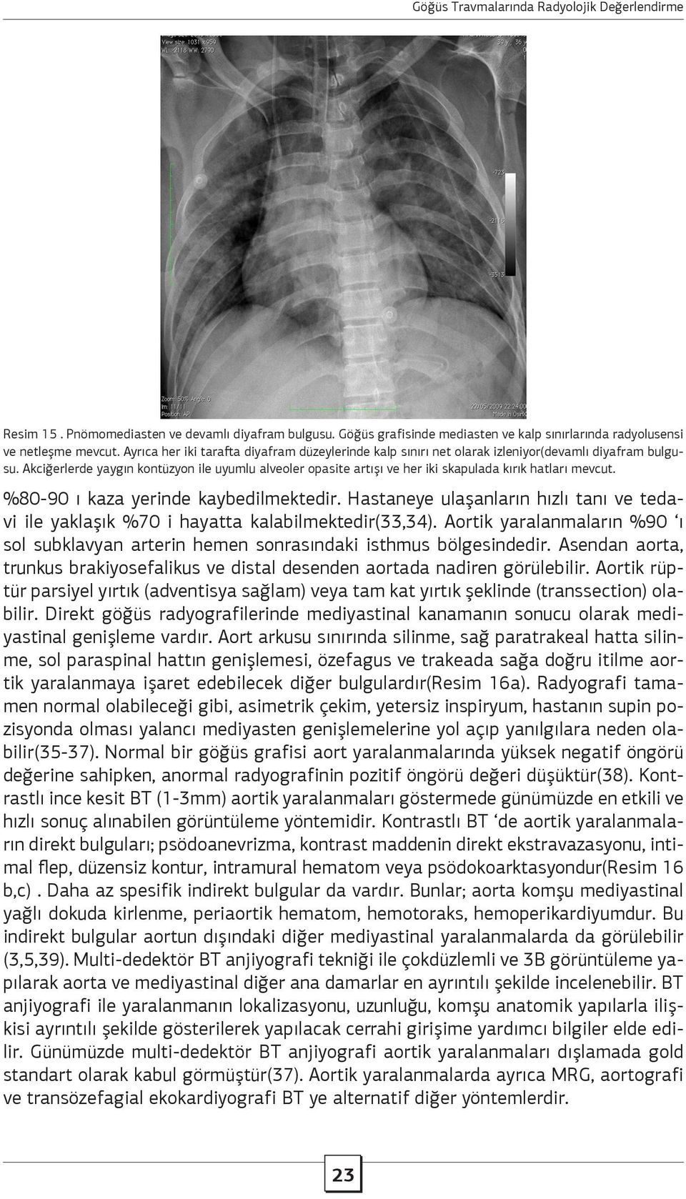 Akciğerlerde yaygın kontüzyon ile uyumlu alveoler opasite artışı ve her iki skapulada kırık hatları mevcut. %80-90 ı kaza yerinde kaybedilmektedir.