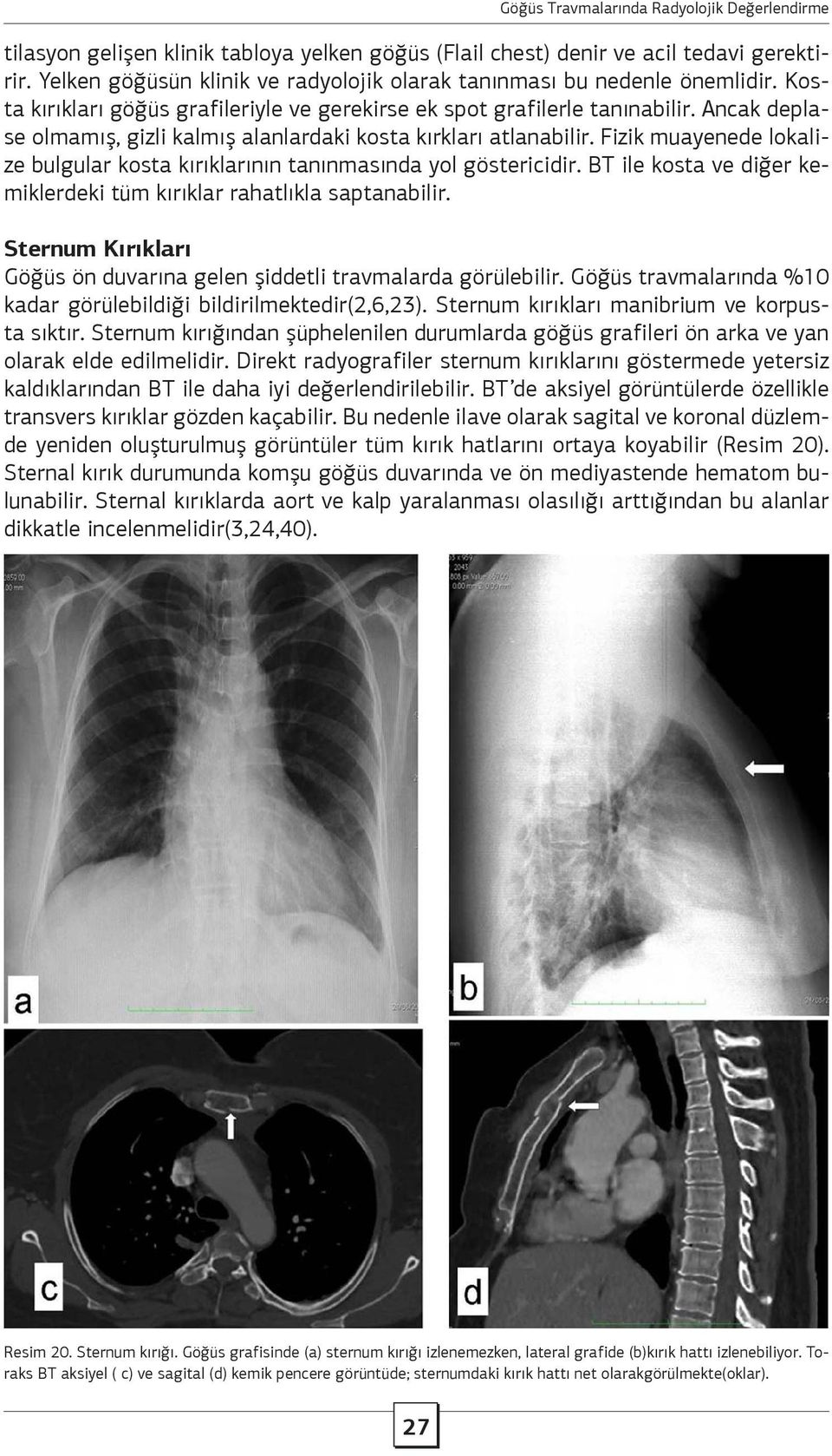 Fizik muayenede lokalize bulgular kosta kırıklarının tanınmasında yol göstericidir. BT ile kosta ve diğer kemiklerdeki tüm kırıklar rahatlıkla saptanabilir.