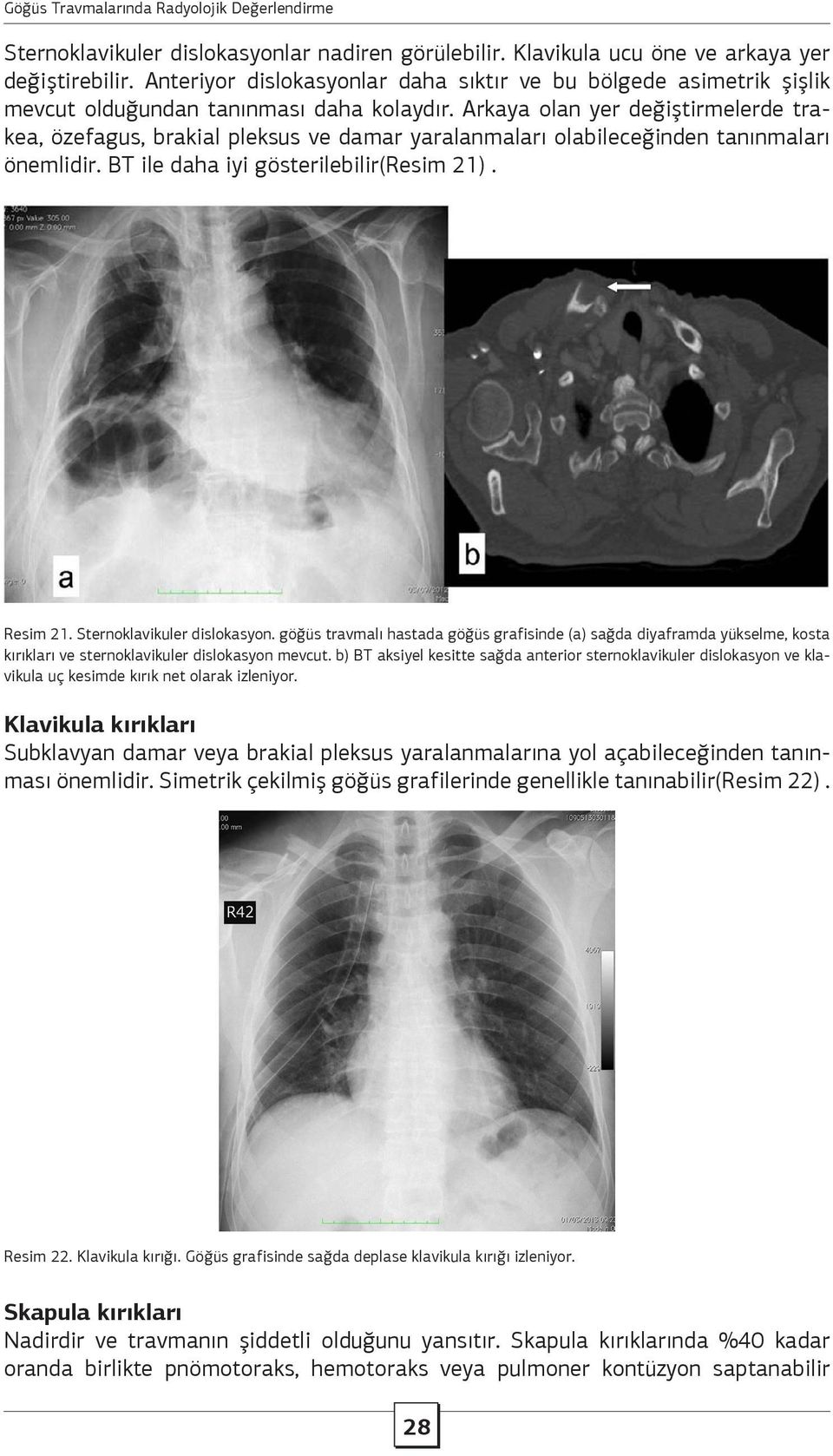 Arkaya olan yer değiştirmelerde trakea, özefagus, brakial pleksus ve damar yaralanmaları olabileceğinden tanınmaları önemlidir. BT ile daha iyi gösterilebilir(resim 21). Resim 21.