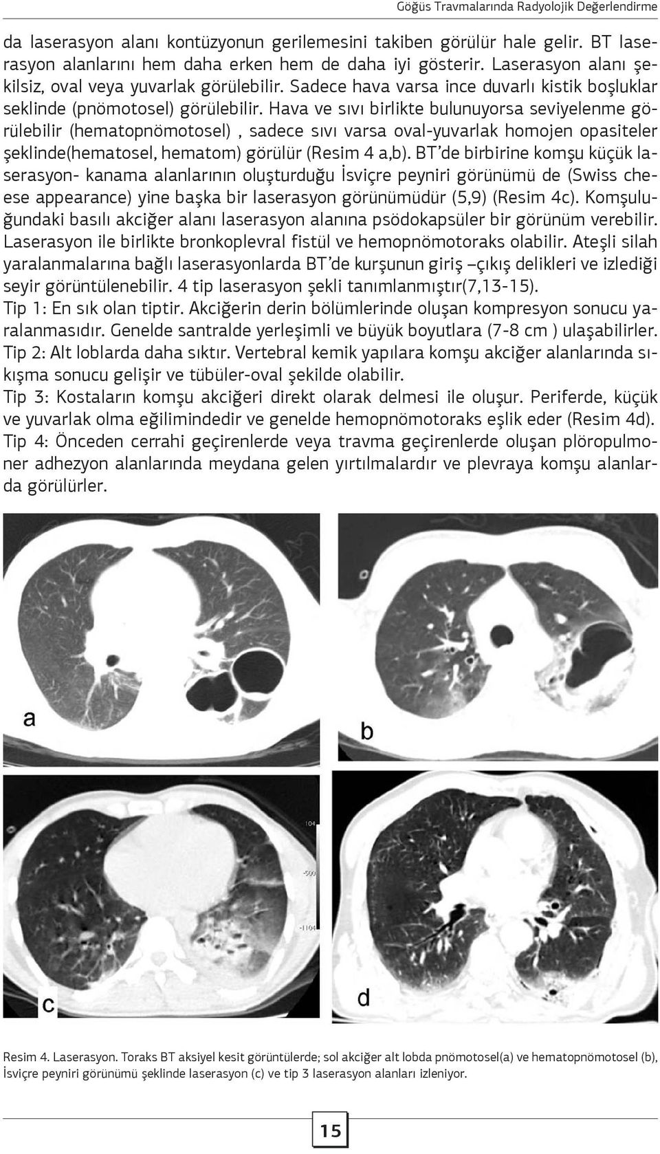 Hava ve sıvı birlikte bulunuyorsa seviyelenme görülebilir (hematopnömotosel), sadece sıvı varsa oval-yuvarlak homojen opasiteler şeklinde(hematosel, hematom) görülür (Resim 4 a,b).