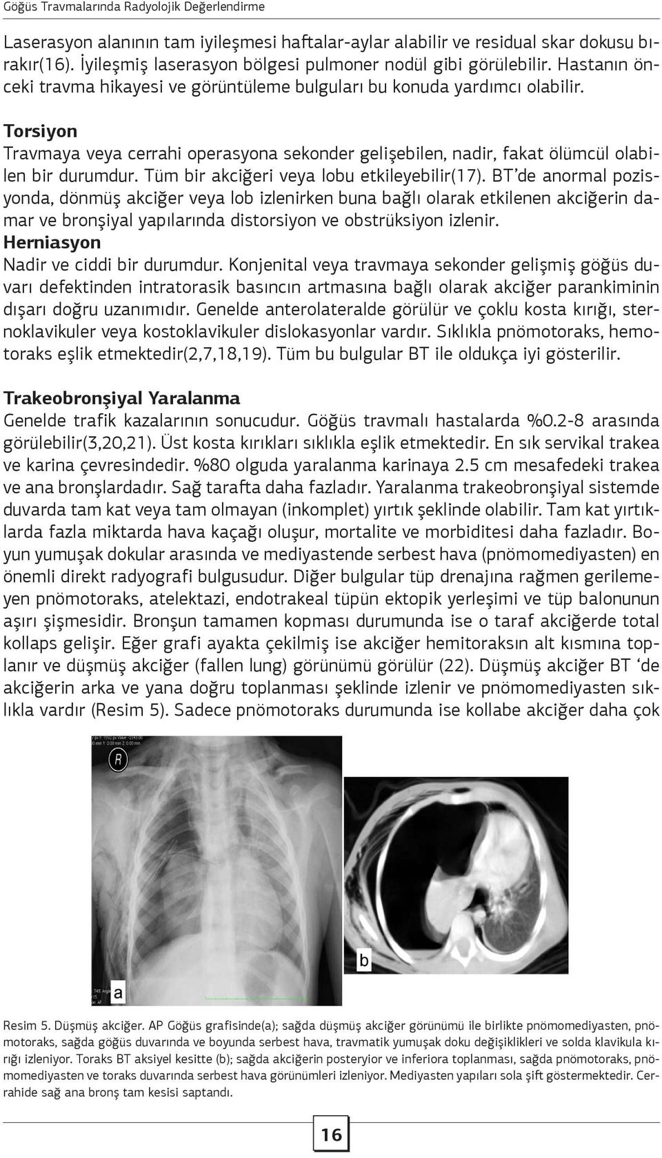 Tüm bir akciğeri veya lobu etkileyebilir(17).