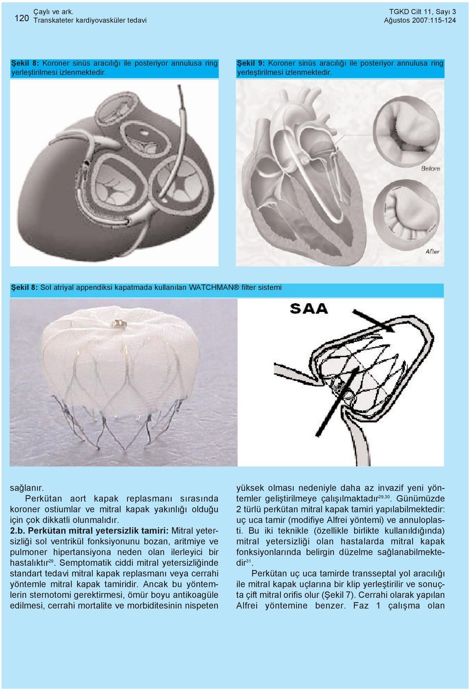 Perkütan aort kapak replasmaný sýrasýnda koroner ostiumlar ve mitral kapak yakýnlýðý olduðu için çok dikkatli olunmalýdýr. 2.b.