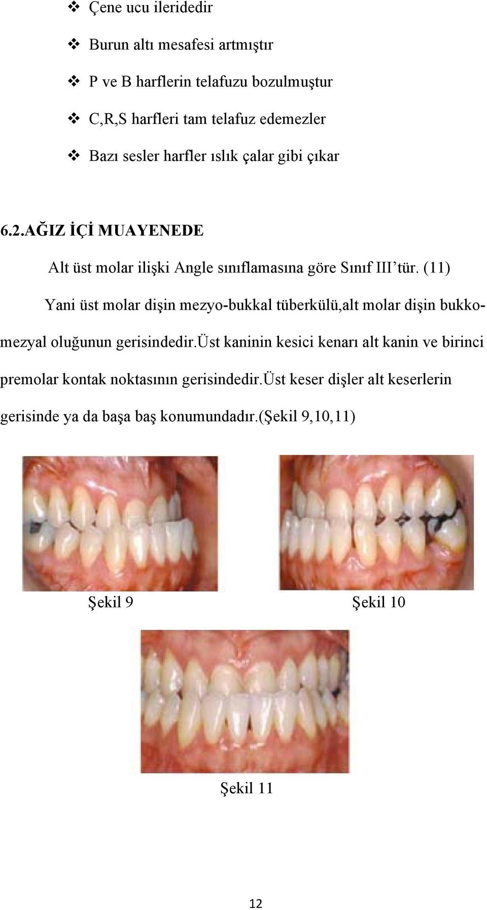 (11) Yani üst molar dişin mezyo-bukkal tüberkülü,alt molar dişin bukkomezyal oluğunun gerisindedir.