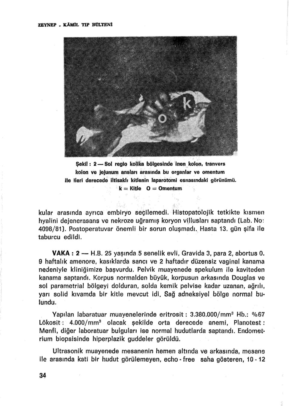 görünümü. k = Kitle O -- Omentum kular arasında ayrıca embiryo seçilemedi. Histopatolojik tetkikte kısmen hyalini dejenerasans ve nekroze uğramış koryon vi.llusları saptandı (Lab. No: 4098/81 ).