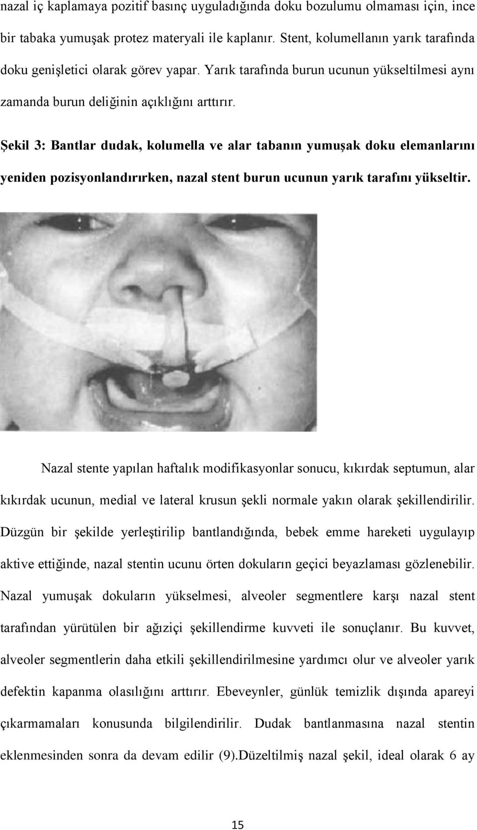 Şekil 3: Bantlar dudak, kolumella ve alar tabanın yumuşak doku elemanlarını yeniden pozisyonlandırırken, nazal stent burun ucunun yarık tarafını yükseltir.