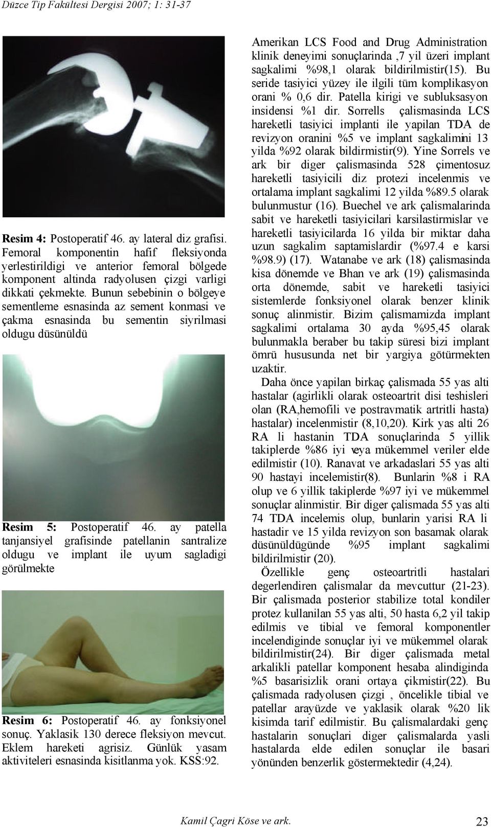 ay patella tanjansiyel grafisinde patellanin santralize oldugu ve implant ile uyum sagladigi görülmekte Resim 6: Postoperatif 46. ay fonksiyonel sonuç. Yaklasik 130 derece fleksiyon mevcut.