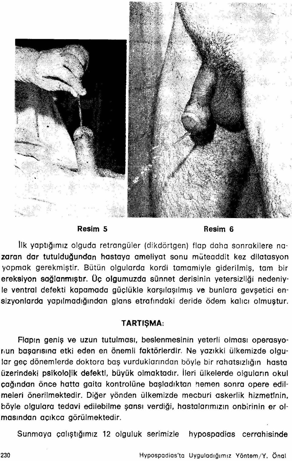 Oc olgumuzda sünnet derisinin yetersizliği nedeniyle ventral defekti kapama da güçlükle karşılaşılmış ve bunlara gevşetici ensizyonlarda yapılmadığından glans etrafındaki deride ödem kalıcı olmuştur.