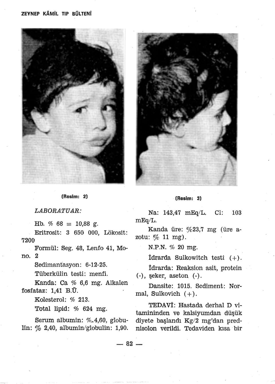 (Resim: 3) Na: 143,47 meq/l. Cl: 103 meq/l. Kanda üre: 1 %23,7 mg (üre a zıotu: '% 11 mg). N.P.N. % 20 mg. İdrarda Sulkowitch testi ( +).