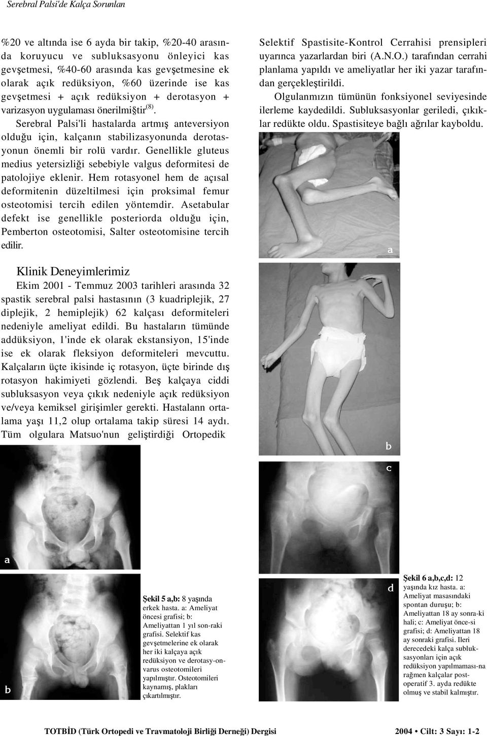 Serebral Palsi'li hastalarda artmış anteversiyon olduğu için, kalçanın stabilizasyonunda derotasyonun önemli bir rolü vardır.