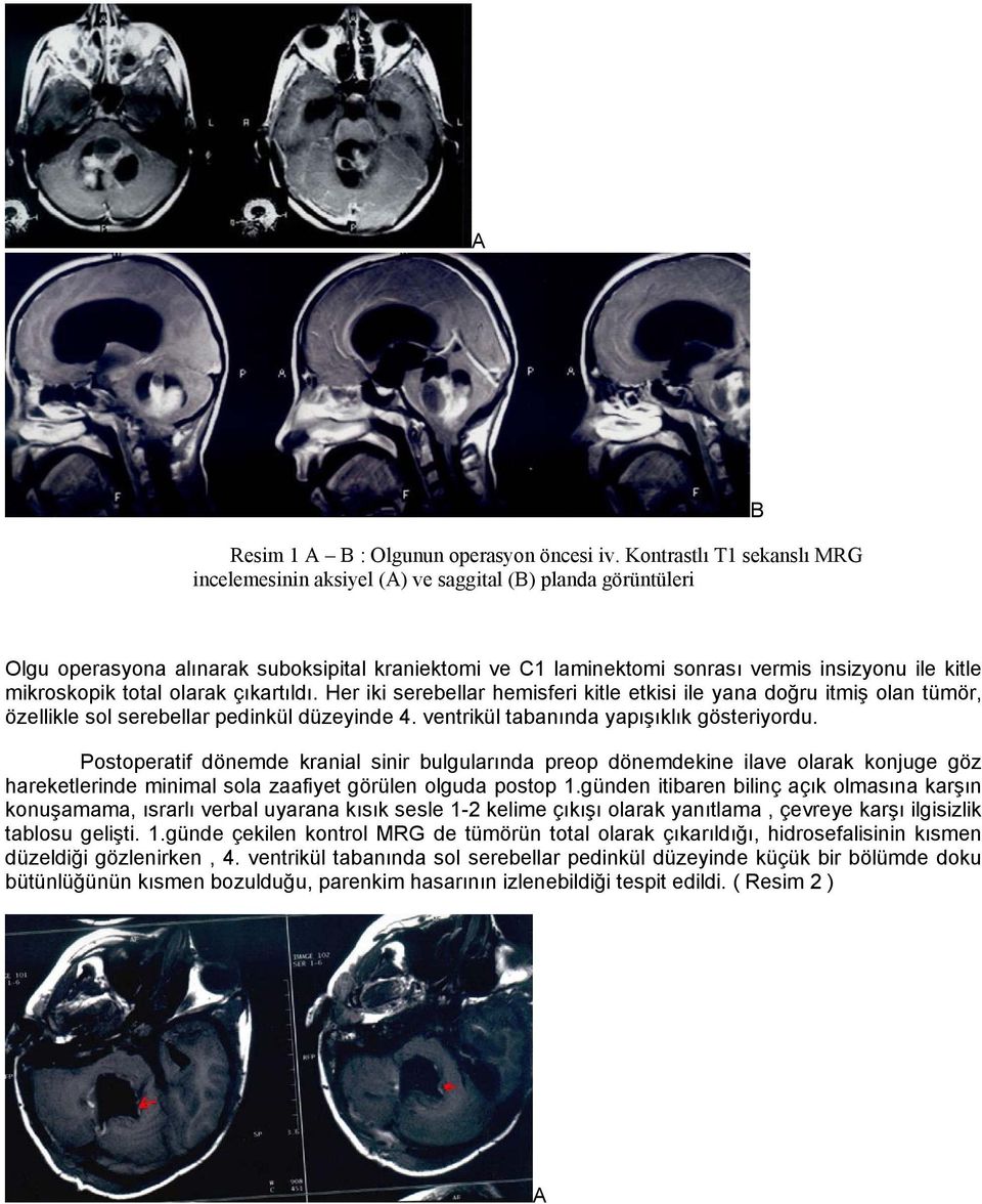 mikroskopik total olarak çıkartıldı. Her iki serebellar hemisferi kitle etkisi ile yana doğru itmiş olan tümör, özellikle sol serebellar pedinkül düzeyinde 4.