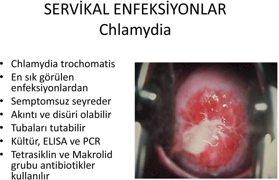 nt ve disüri olabilir Tubalar tutabilir Kültür, ELISA ve