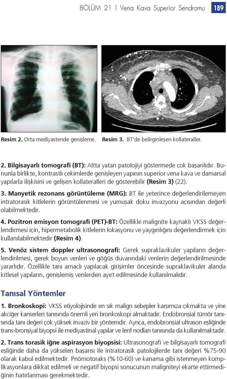 (22). 3. Manyetik rezonans görüntüleme (MRG): BT ile yeterince değerlendirilemeyen intratorasik kitlelerin görüntülenmesi ve yumuşak doku invazyonu açısından değerli olabilmektedir. 4.