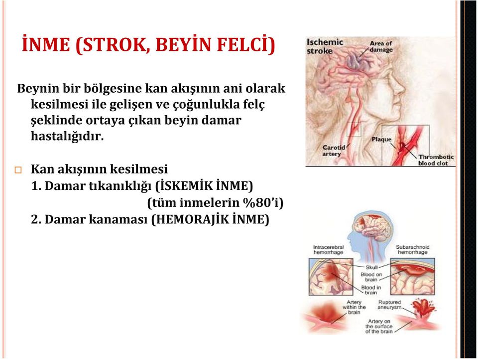 beyin damar hastalığıdır. Kan akışının kesilmesi 1.