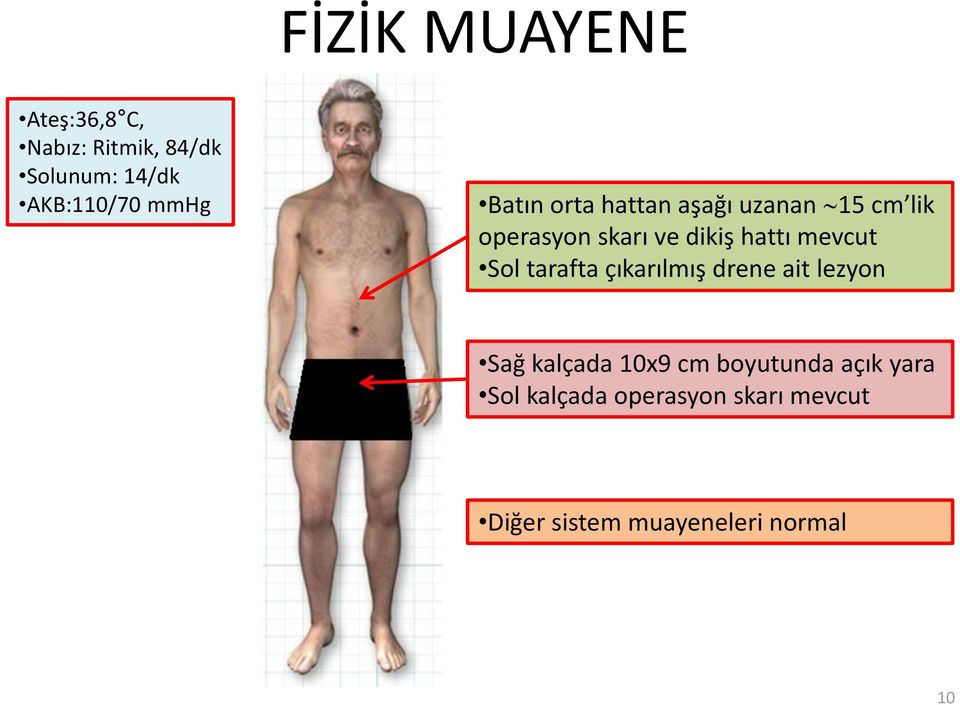 mevcut Sol tarafta çıkarılmış drene ait lezyon Sağ kalçada 10x9 cm boyutunda