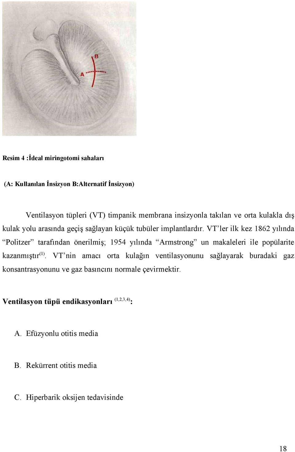 VT ler ilk kez 1862 yılında Politzer tarafından önerilmiş; 1954 yılında Armstrong un makaleleri ile popülarite kazanmıştır (1).