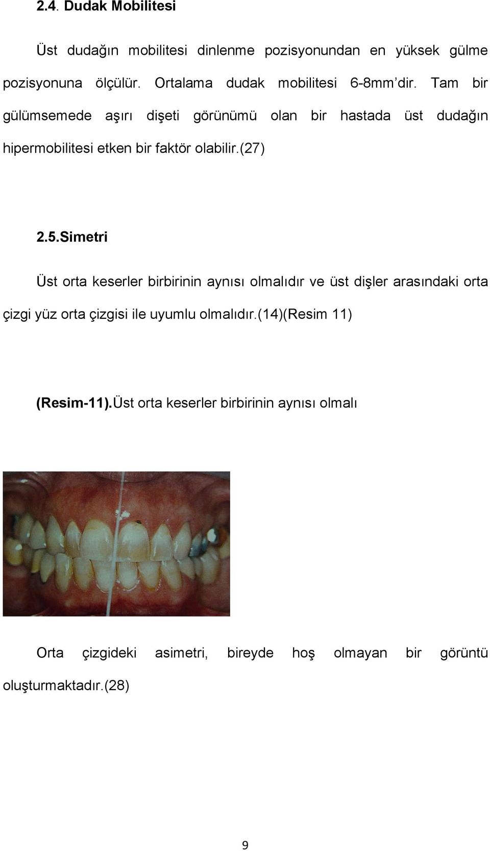 Tam bir gülümsemede aşırı dişeti görünümü olan bir hastada üst dudağın hipermobilitesi etken bir faktör olabilir.(27) 2.5.