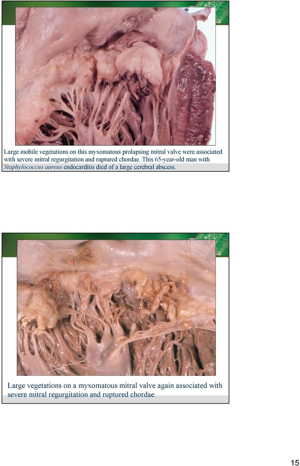 This65-year-oldman with Staphylococcusaureus endocarditisdied of a