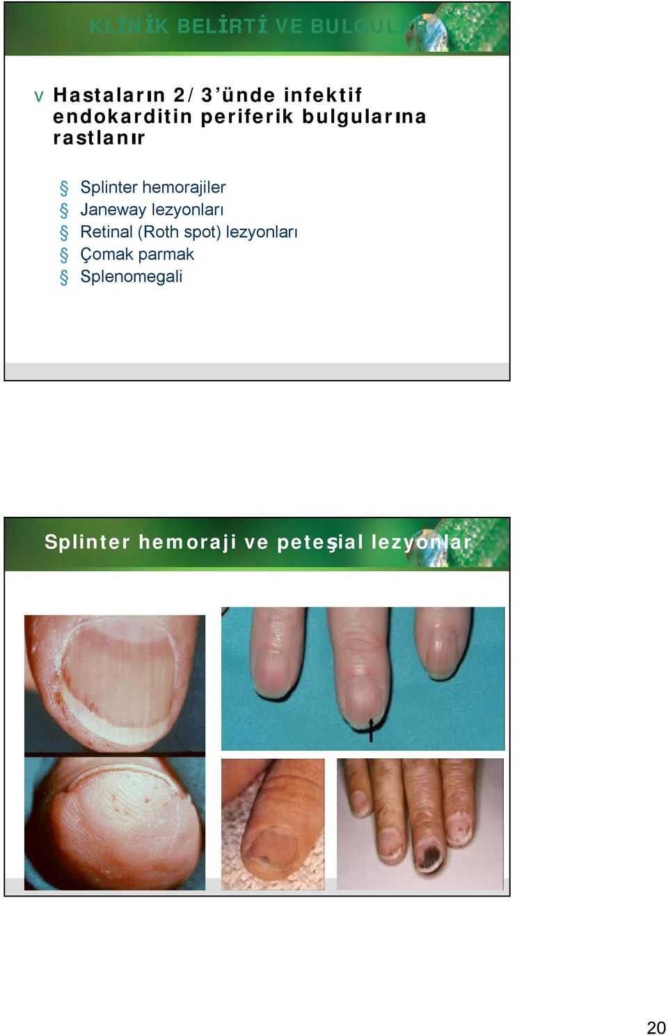 hemorajiler Janeway lezyonları Retinal (Roth spot)
