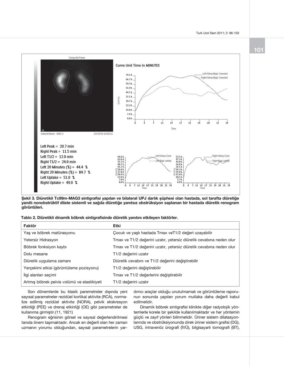 bir hastada diüretik renogram görüntüleri. Tablo 2. Diüretikli dinamik böbrek sintigrafisinde diüretik yanıtını etkileyen faktörler.