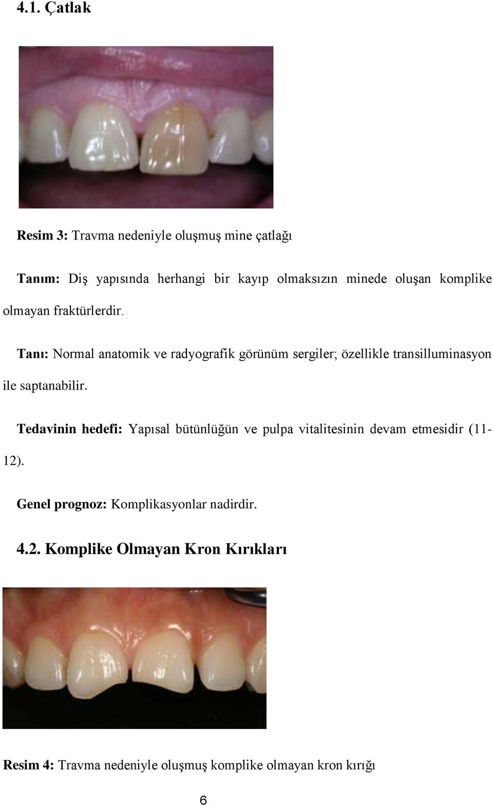 Tanı: Normal anatomik ve radyografik görünüm sergiler; özellikle transilluminasyon ile saptanabilir. 12).