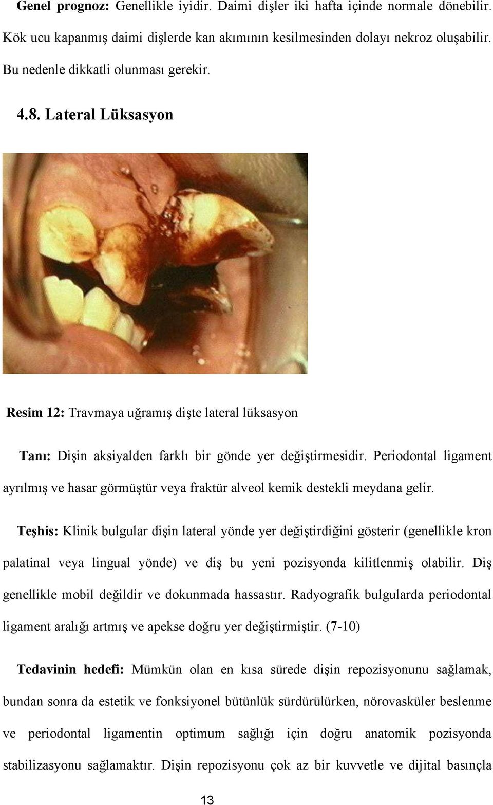 Periodontal ligament ayrılmış ve hasar görmüştür veya fraktür alveol kemik destekli meydana gelir.