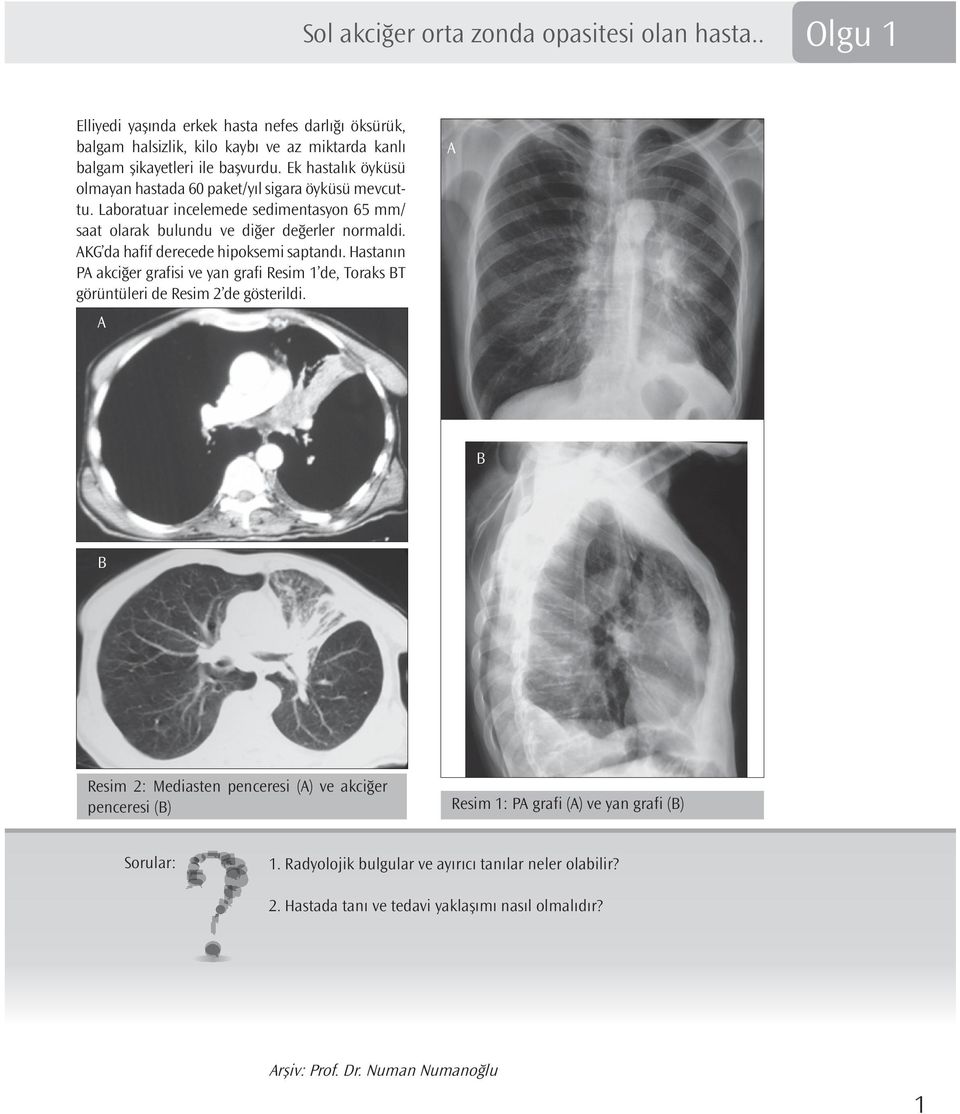 AKG da hafif derecede hipoksemi saptandı. Hastanın PA akciğer grafisi ve yan grafi Resim 1 de, Toraks BT görüntüleri de Resim 2 de gösterildi.