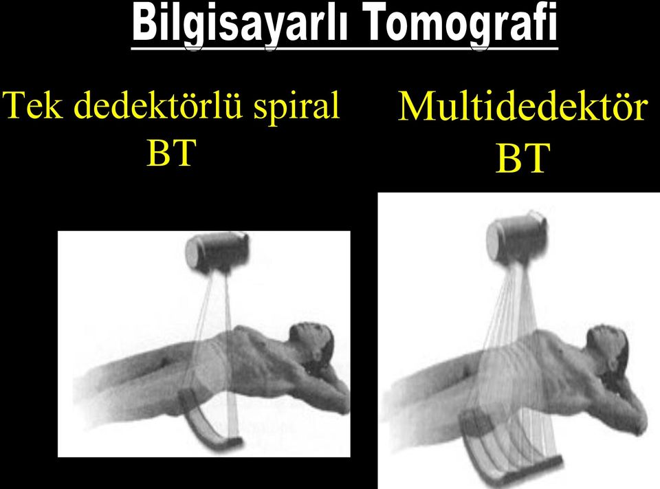 spiral BT