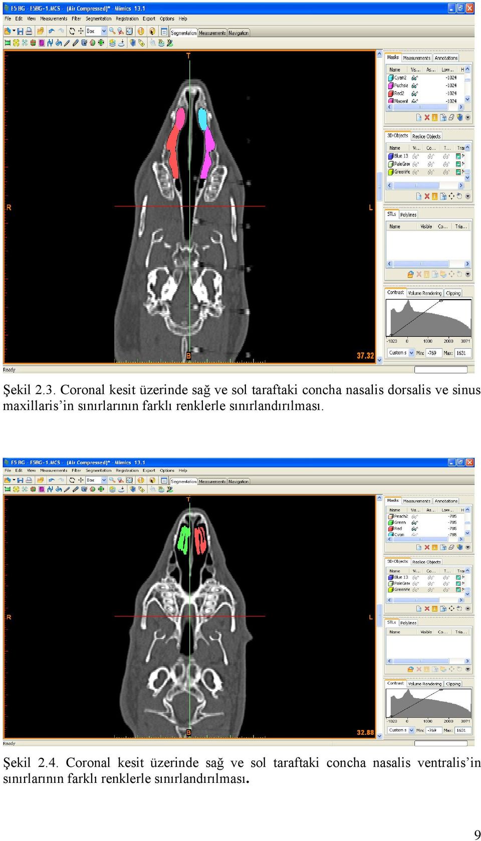 sinus maxillaris in sınırlarının farklı renklerle sınırlandırılması.