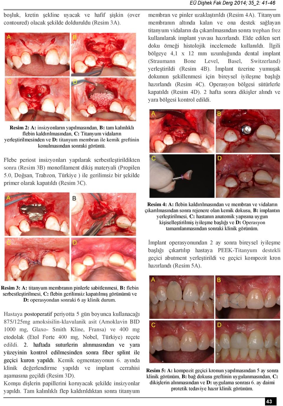 Elde edilen sert doku örneği histolojik incelemede kullanıldı. İlgili bölgeye 4,1 x 12 mm uzunluğunda dental implant (Straumann Bone Level, Basel, Switzerland) yerleştirildi (Resim 4B).