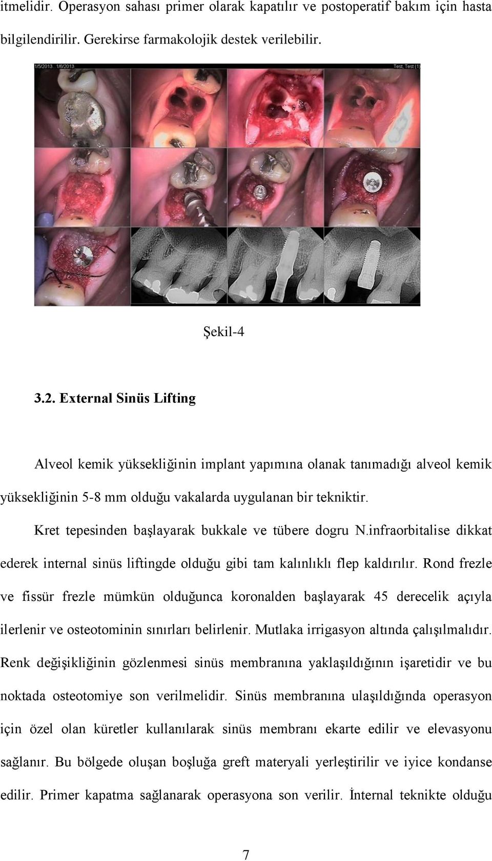 Kret tepesinden başlayarak bukkale ve tübere dogru N.infraorbitalise dikkat ederek internal sinüs liftingde olduğu gibi tam kalınlıklı flep kaldırılır.