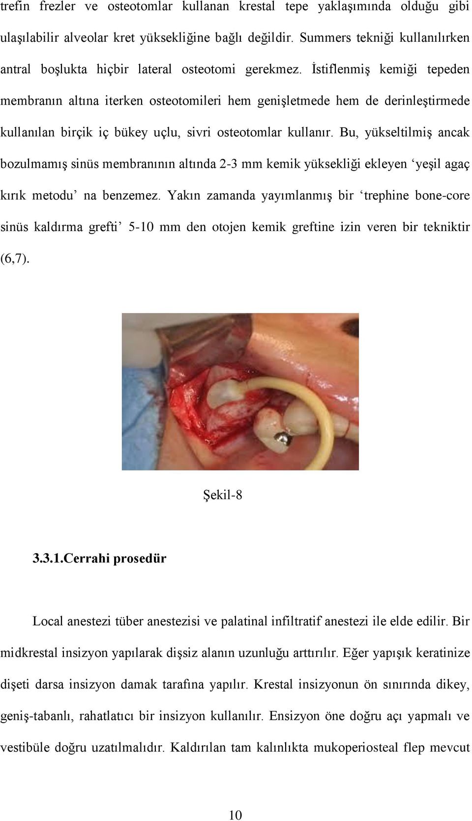 İstiflenmiş kemiği tepeden membranın altına iterken osteotomileri hem genişletmede hem de derinleştirmede kullanılan birçik iç bükey uçlu, sivri osteotomlar kullanır.