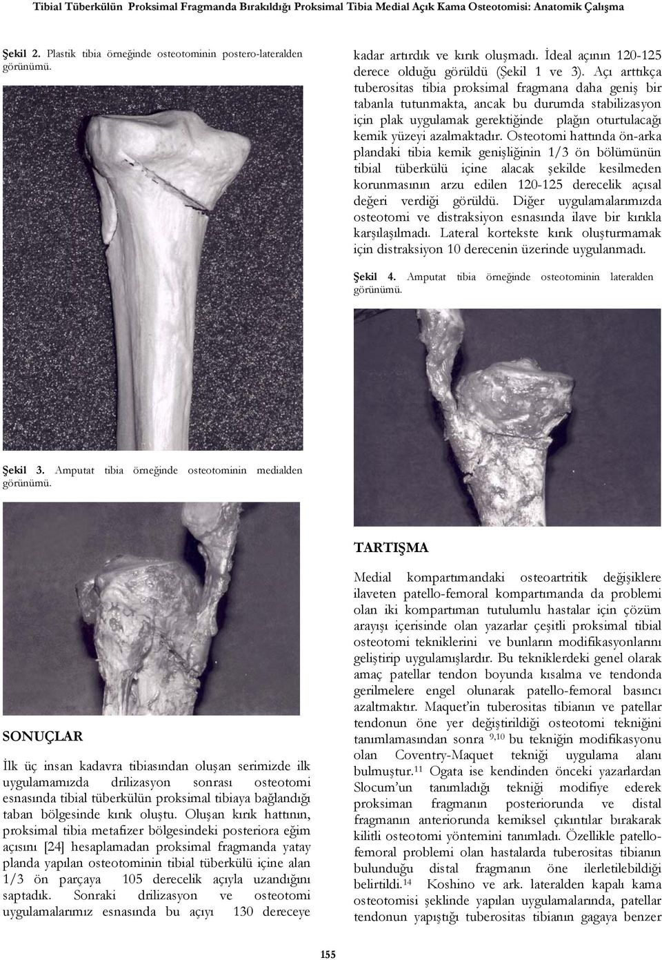 Açı arttıkça tuberositas tibia proksimal fragmana daha geniş bir tabanla tutunmakta, ancak bu durumda stabilizasyon için plak uygulamak gerektiğinde plağın oturtulacağı kemik yüzeyi azalmaktadır.